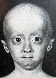 Niño con síndrome de progeria