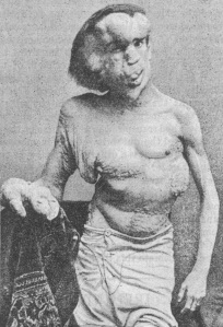Joseph Merrick, hacia 1886. Afectado por Síndrome de Proteus